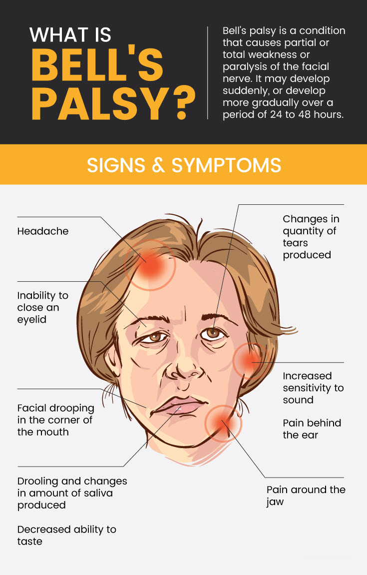 Bell's palsy signs and symptoms