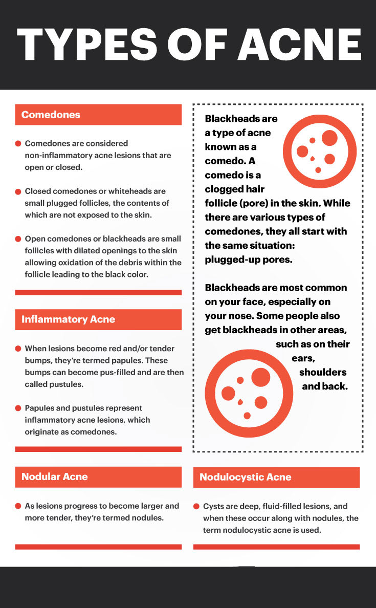 Types of Acne Info