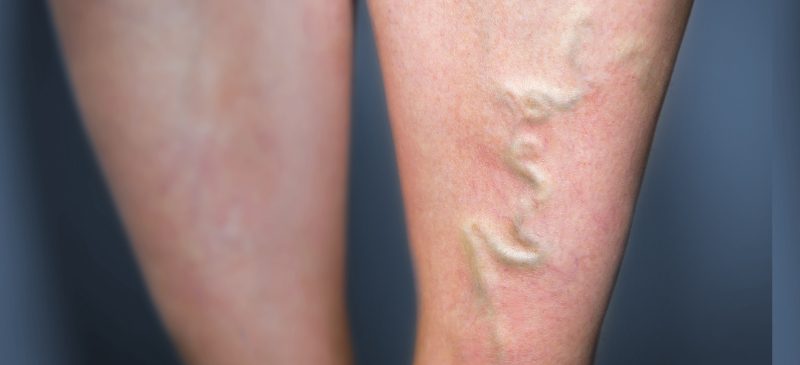 Phlebitis - MKexpress.net