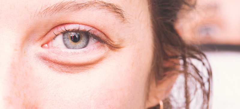 How to get rid of bags under the eyes - MKexpress.net