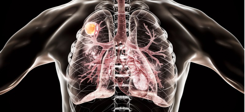 Immunocompromised MKexpressnet