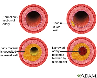 Arterial Insufficiency