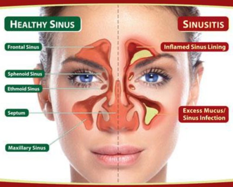 Sinus Infection Symptoms