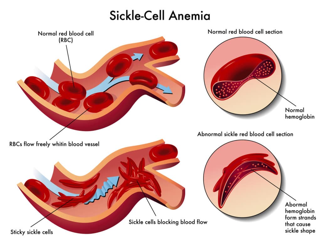 How Anemia is Diagnosed