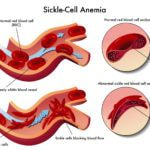 How Anemia is Diagnosed and Treatment Options How Anemia is Diagnosed