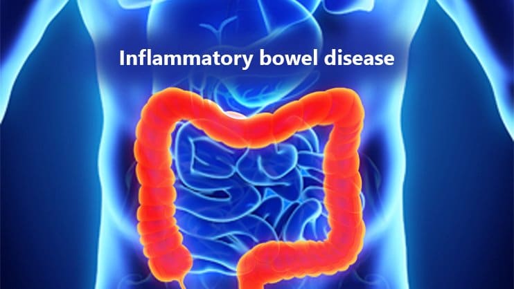 Inflammatory Bowel Disease