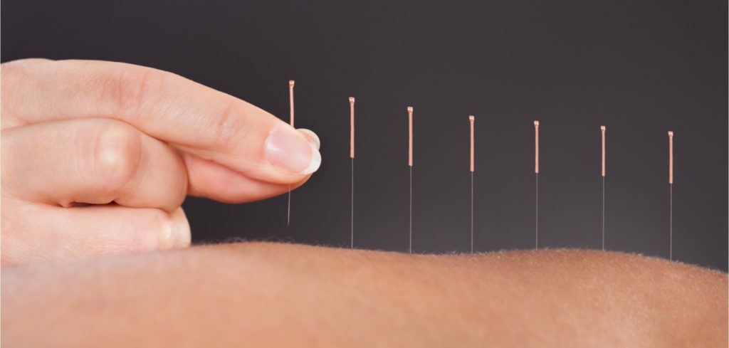 Acupuncture Unraveled