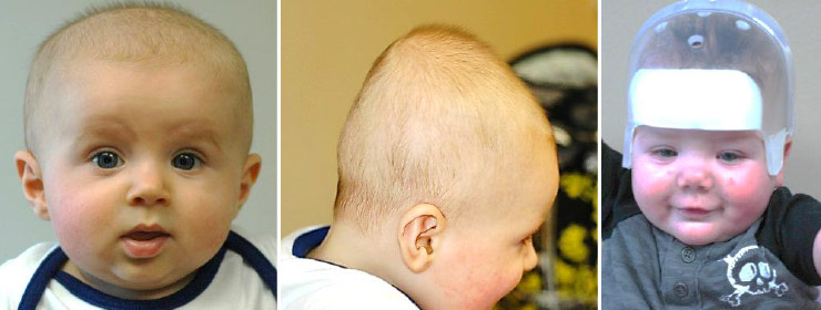 Craniofacial Abnormalities
