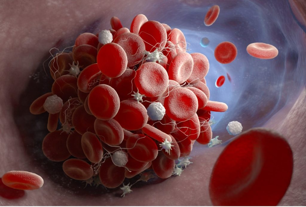 Embolism Definition Medical
