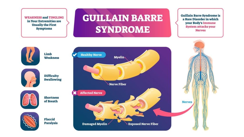 Guillain Barré Syndrome