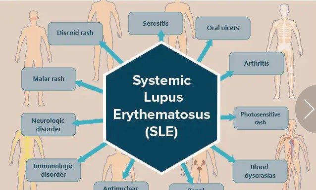 Lupus: Symptoms, Causes And Research Lupus