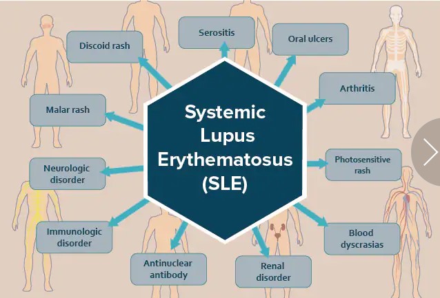 Lupus