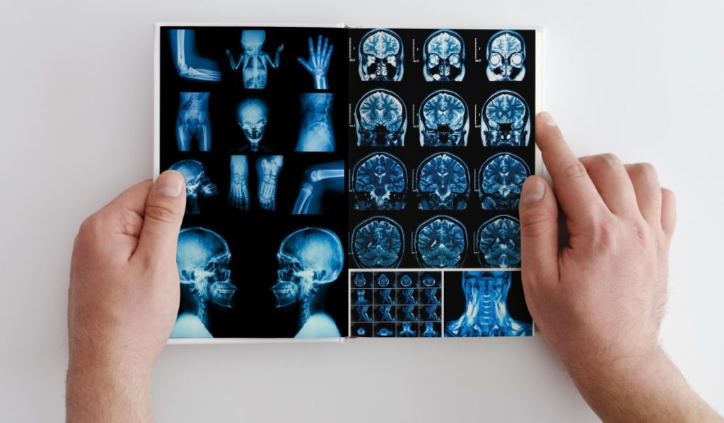Multiple sclerosis