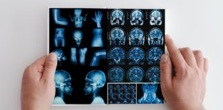 Multiple Sclerosis (MS): Symptoms, Types, and Causes Multiple sclerosis