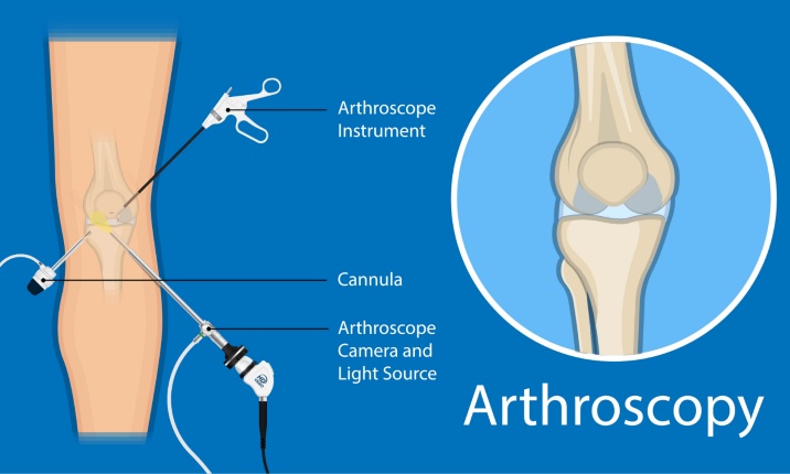 Arthroscopy