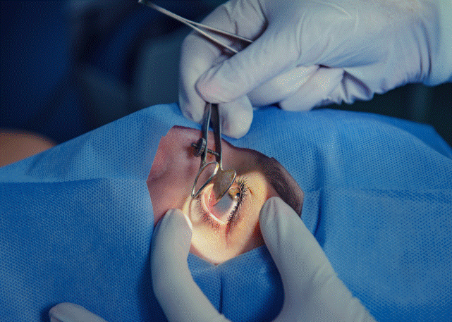 Cataract Surgery