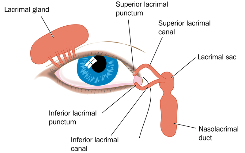 Lacrimal Duct Obstruction
