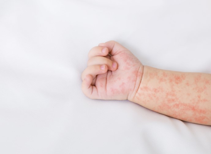 Measles: 4 Dangerous Signs And Symptoms To Check