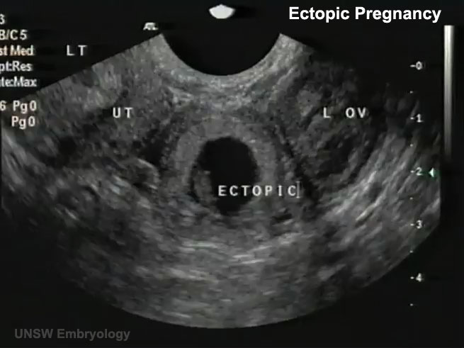 Transvaginal Ultrasound