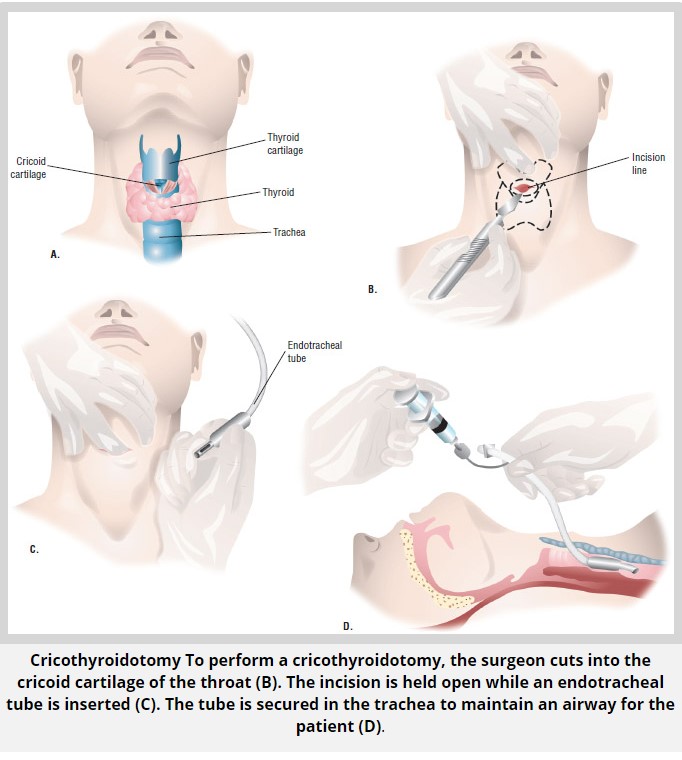 cricothyroidotomy