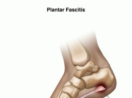 plantar fasciitis