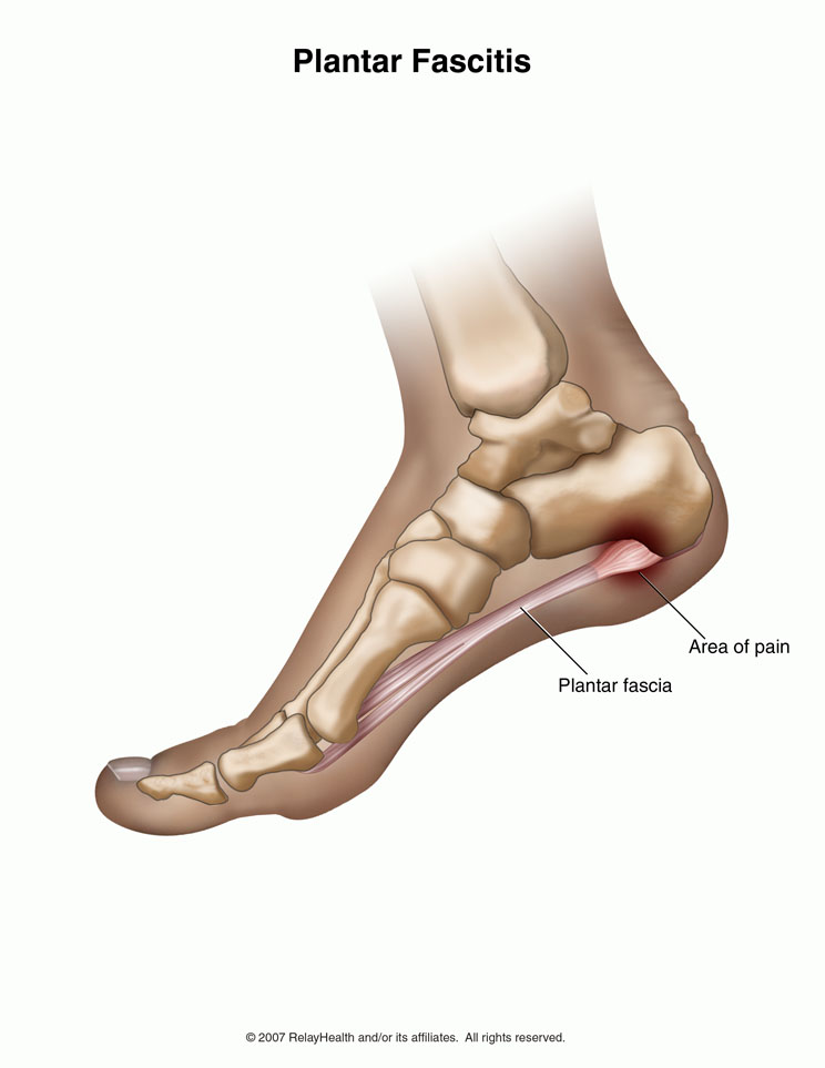 plantar fasciitis