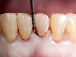 Periodontal Tissue Regeneration