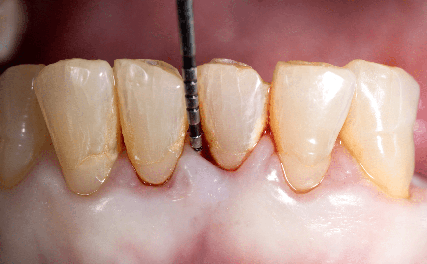 Periodontal Tissue Regeneration