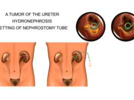 Complete Guide to Nephrostomy Tube Care